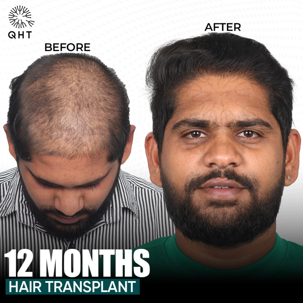 Hair Transplant