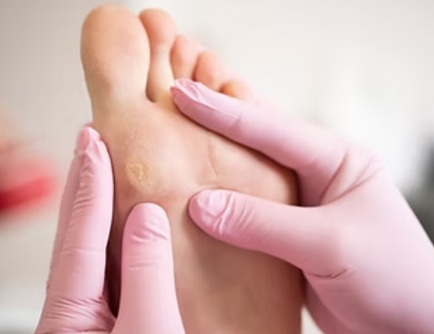 What Is the Best Foot Corn Removal Treatment in Singapore?