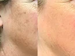 laser brown spot removal