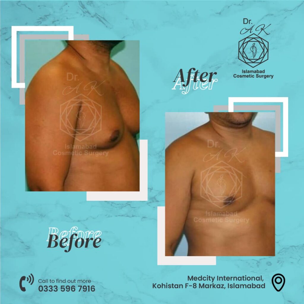 gynecomastia surgery in islamabad