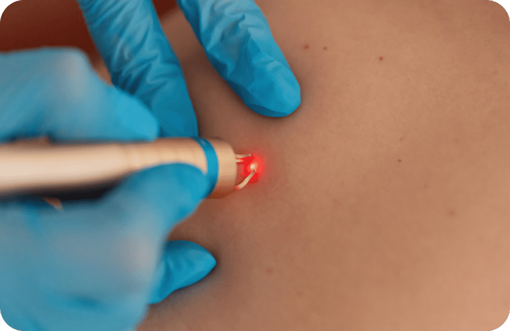 Skin Tags Removal in Dubai