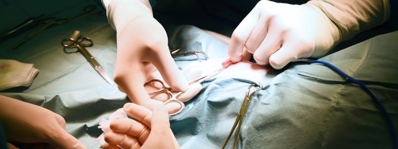 Understanding Pilonidal Wound Healing Stages