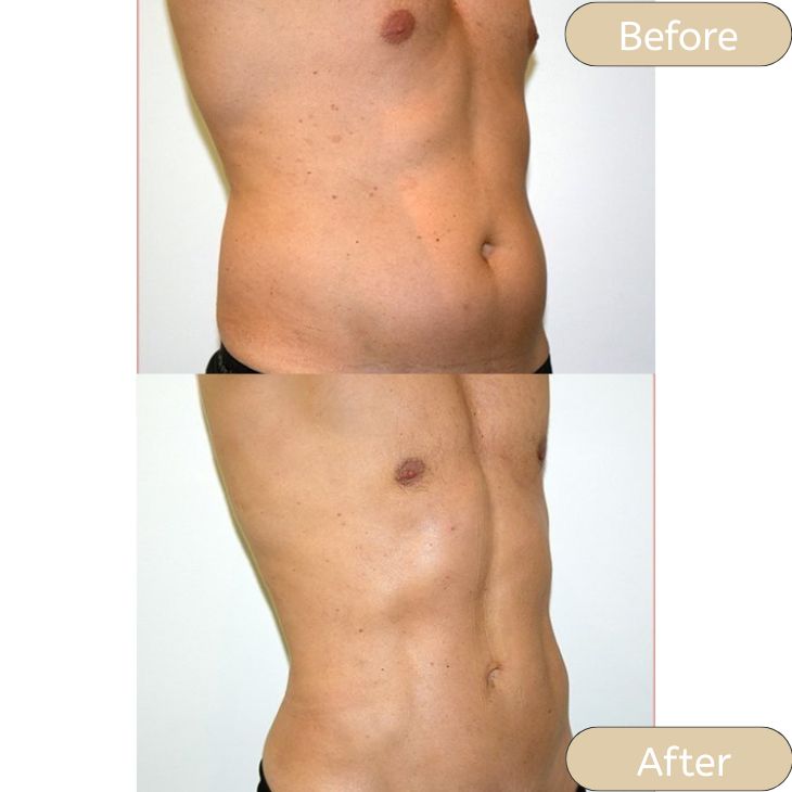 Laser Liposuction Versus Traditional Methods for Smoother Body Contouring