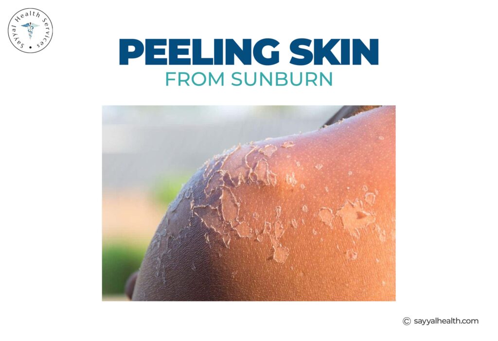peeling skin from sunburn