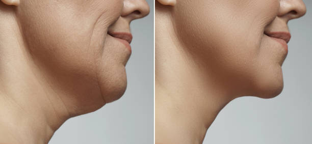 Double Chin Removal in Abu Dhabi