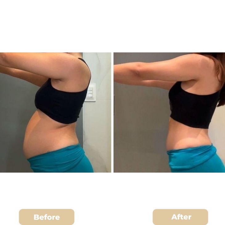 Liposuction Recovery in Dubai: Everything You Need to Know