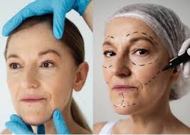 facelift in Adelaide